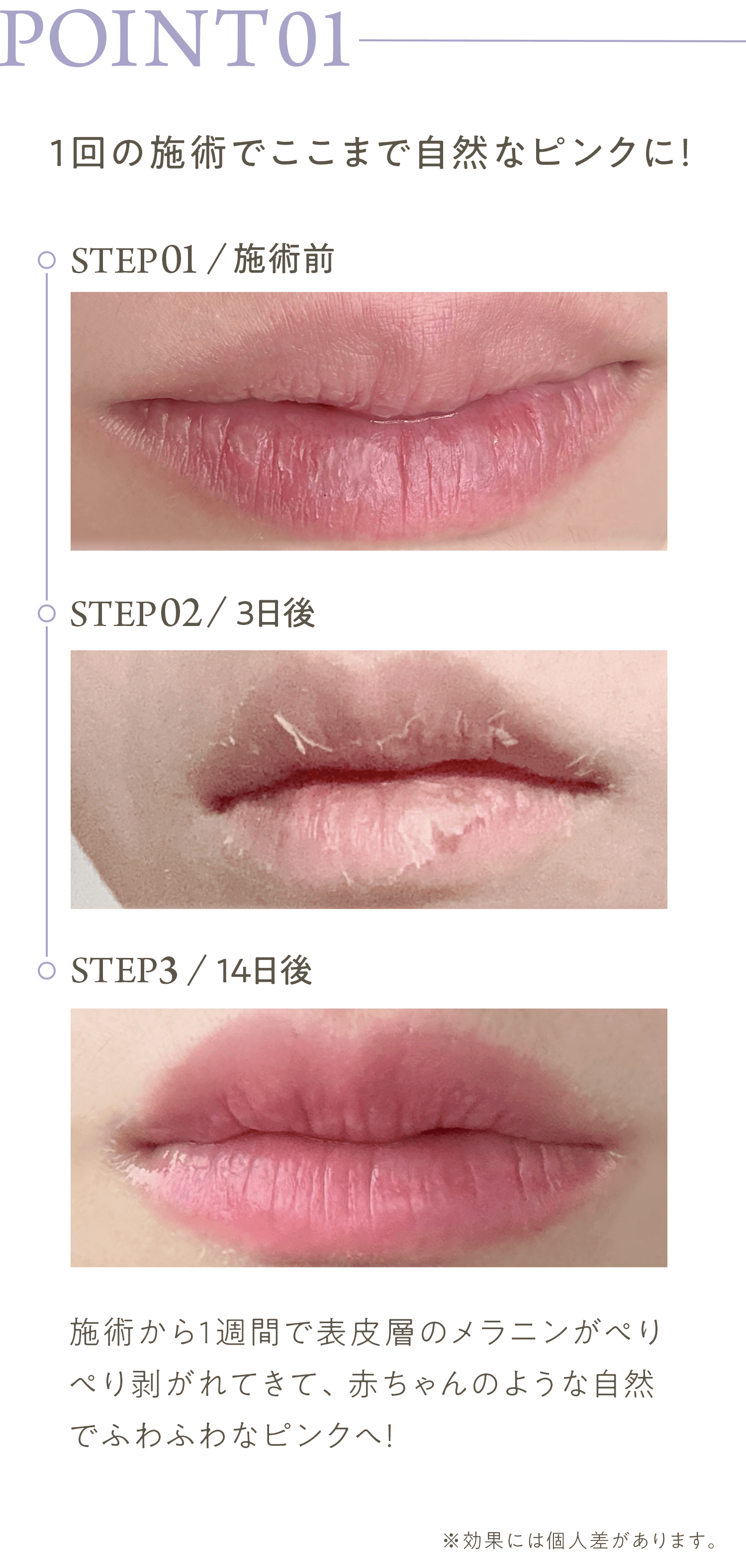 1回の施術でここまで自然なピンクに!施術から1週間で表皮層のメラニンがぺりぺり剥がれてきて、従来の黒ずみケアでは引き出せない赤ちゃんのような自然でふわふわなピンクへ!※効果には個人差があります。